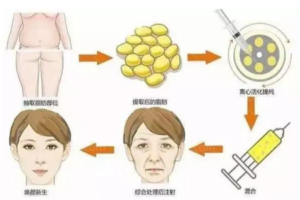 韩国珠儿丽整形医院脂肪填充经历 老气脸秒变气质女神全靠它！