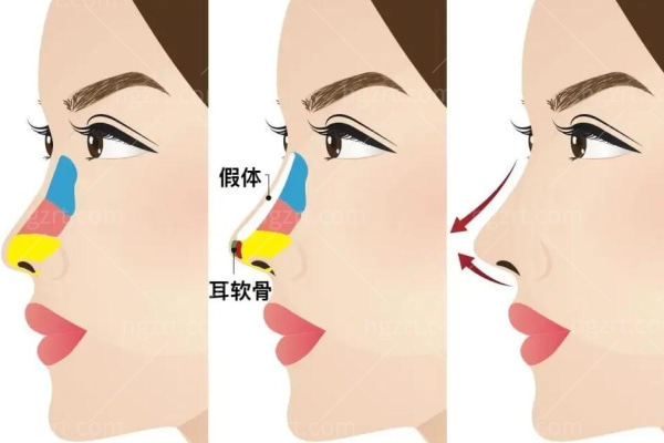 隆鼻70%的人都选错！8种隆鼻方式的优缺点你要知道