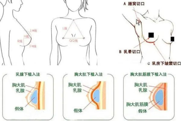 做假体隆胸？假体隆胸大家关心的5个问题来唠唠