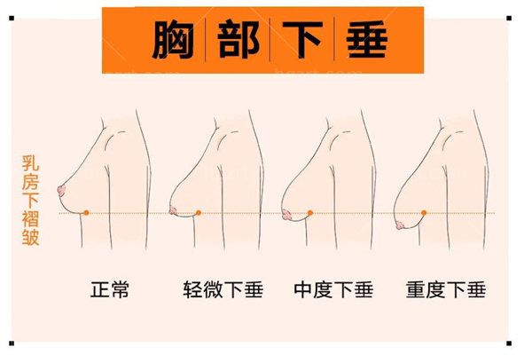 乳房双环悬吊术是怎么做的？五大步骤可获美胸维持时间长褶皱会扁平