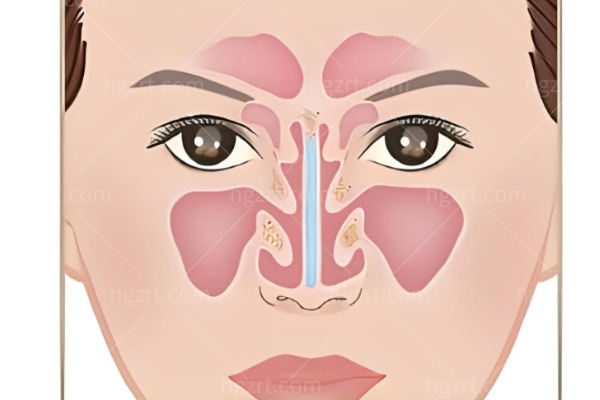 分享我做鼻修复手术的经历 赴京摆脱假鼻子换一张脸心酸历程！