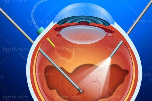 视网膜脱落手术费用大概多少钱？来看看视网膜脱落跟玩手机有关系不