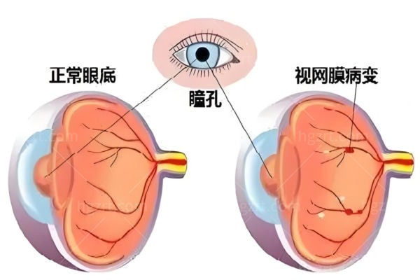 视网膜色素变性现在能治吗?可治会遗传影响寿命需及时治疗