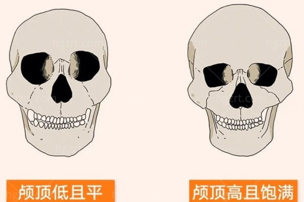 骨水泥填充后脑勺、头顶怎么样