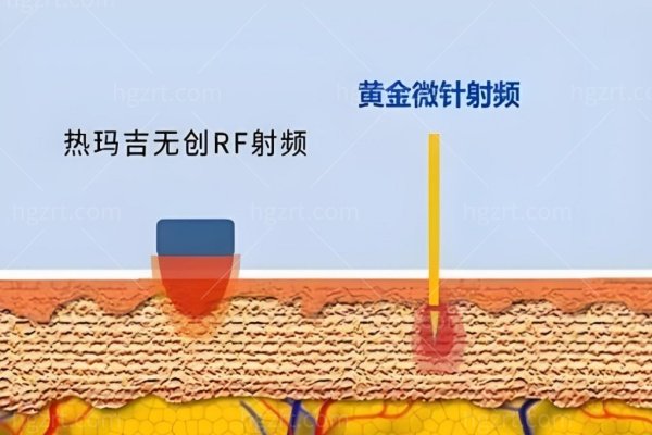 黄金微针和微针的区别