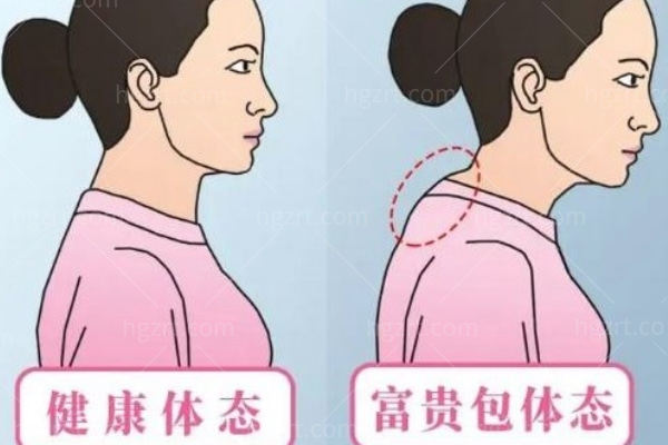 富贵包抽脂好还是切除