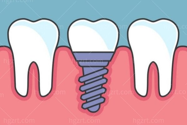 牙齿植骨有什么风险和后遗症