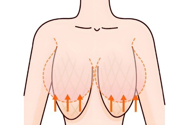 双环提升乳房手术步骤