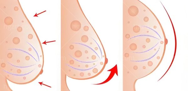 双环提升乳房优缺点