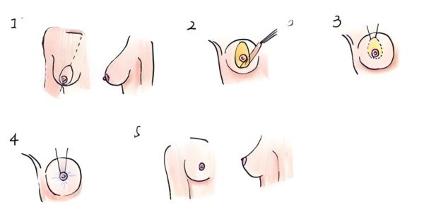 乳房下垂矫正手术会留疤吗