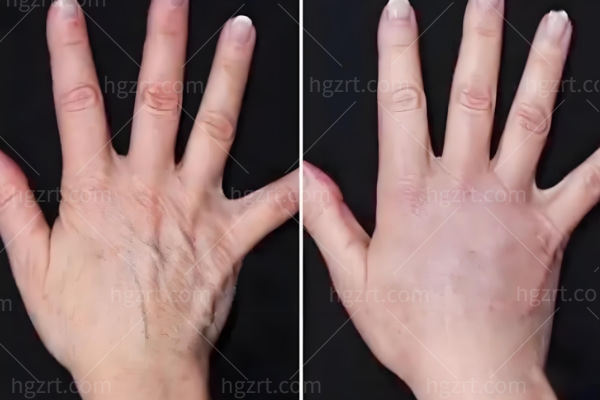 手部脂肪填充能保持几年?青筋突出/手指干瘪/手部松弛褶皱/改善手部年龄存活率高