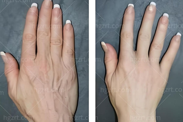 手部脂肪填充能保持几年?青筋突出/手指干瘪/手部松弛褶皱/改善手部年龄存活率高