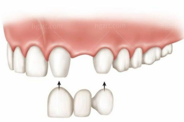 无挂钩假牙怎么固定的?优缺点和种植牙价格哪个贵浅来分析一波