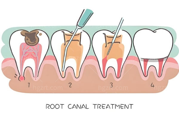 根管治疗
