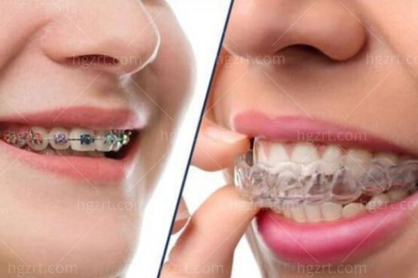 韩国Le牙科五月六月活动公布：留学生补牙正畸优惠10%不要太给力
