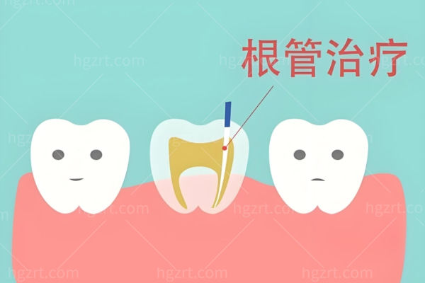 2024年根管治疗收费标准明细更新 乳牙/前牙/双尖牙/前磨牙/后槽牙500-4000+均曝光