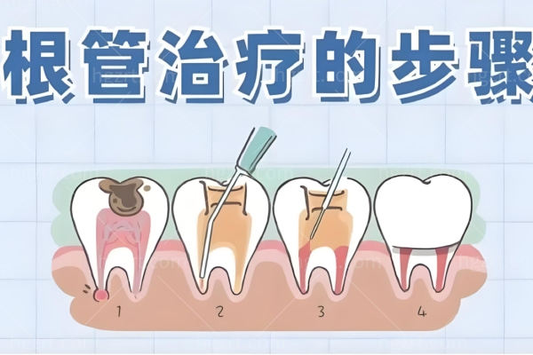 2024年根管治疗收费标准明细更新 乳牙/前牙/双尖牙/前磨牙/后槽牙500-4000+均曝光