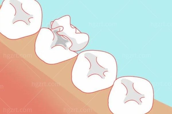 补牙修复四种方式是什么?3M纳米树脂/嵌体/美容冠/牙贴面都可价格不贵又好