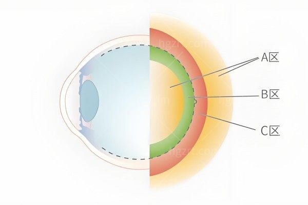 视网膜脱离可以做保守治疗吗？有没有眼科医生回答？