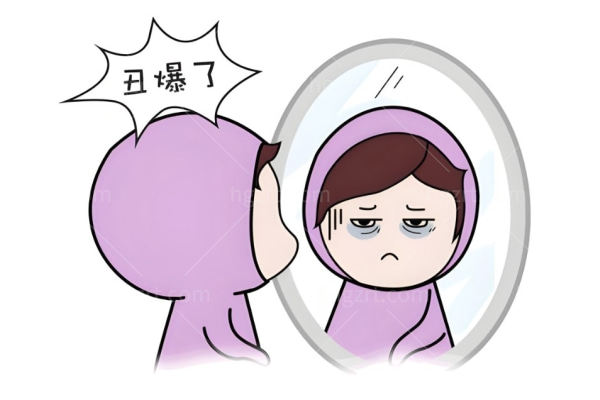 在郑州缔莱美做了不开刀眼袋手术,真的是太香了过程舒适恢复也好
