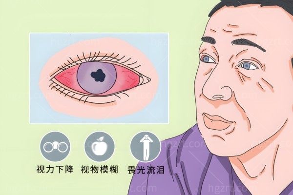 脉络膜病变能治好吗?是葡萄膜炎的一种眼疾致盲性高发病较为隐匿要重视！