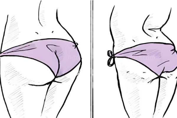 分享翘臀整形过程 来看看臀部整形是个什么样的体验简直爱到无法自拔