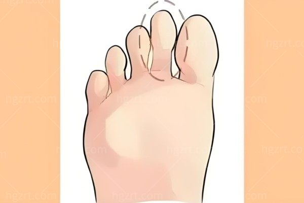 二脚趾缩短微创手术国内谁做的比较好?马桂文/苏敬达/张荣辉即做即走不复发10000+