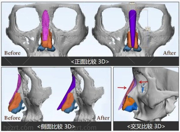 韩国3d打印鼻比较好的医院排行榜