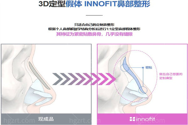 3D定制假体鼻整形术