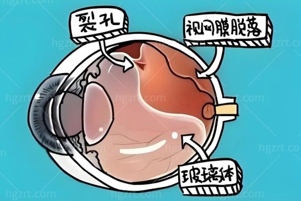 国内眼科四把刀是谁 郝燕生/叶子隆/黎晓新/马志中眼科技术嘎嘎好！