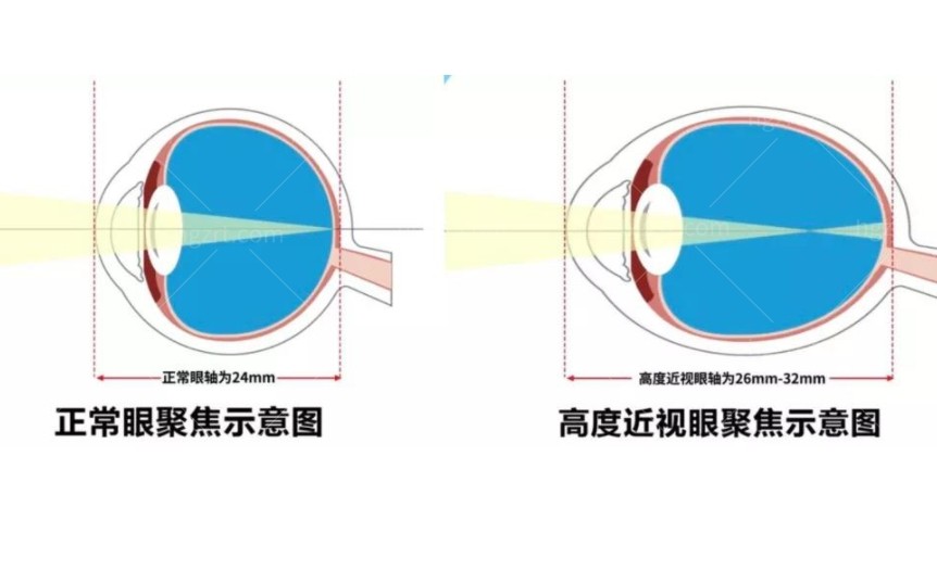 中山爱尔眼科医院是正规吗