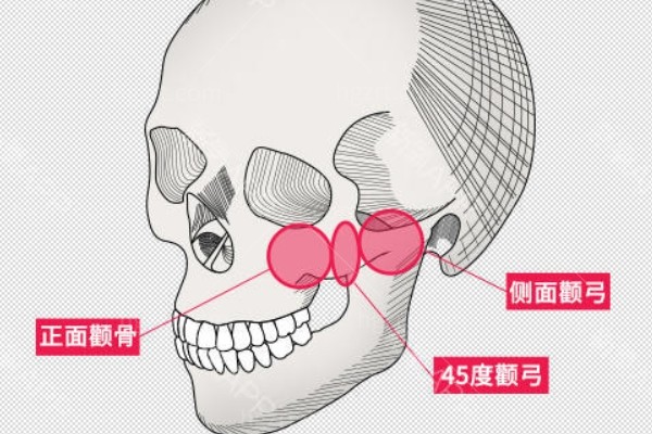 高俊明做下颌角怎么样？