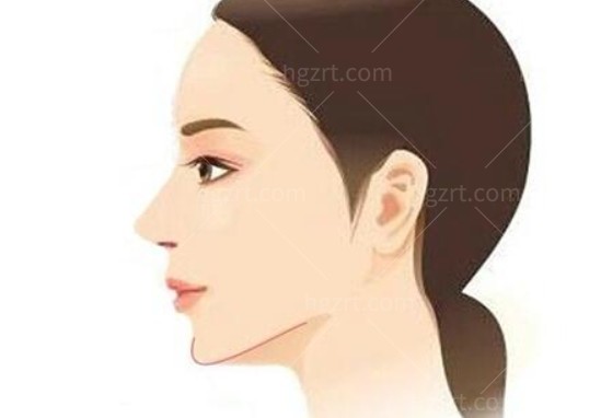 高俊明做下颌角怎么样？