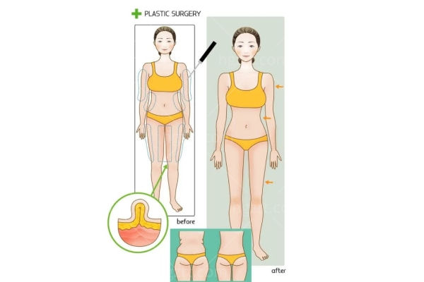 全身360度环形吸脂价格