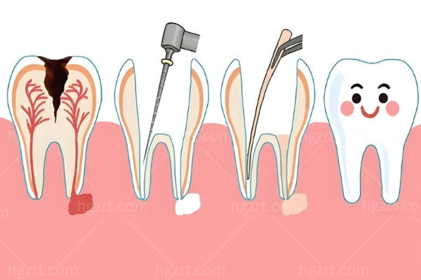 什么情况下需要做根管治疗