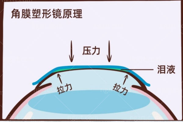 成都角膜塑形镜哪里配好