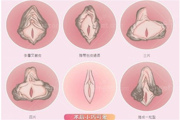 女性私密整形