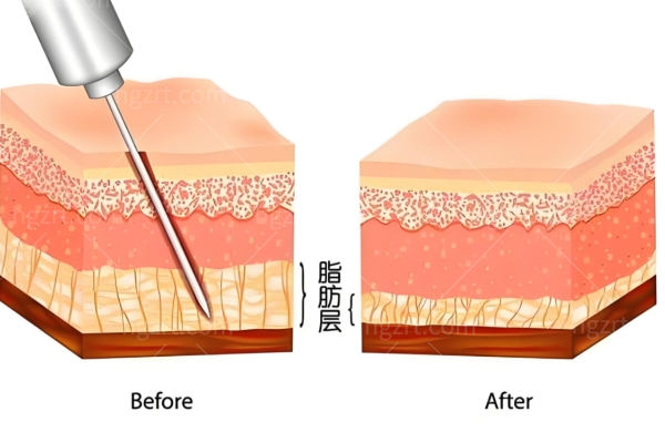 如生天使是胶原蛋白吗?是生长因子吗?和濡白天使的区别是什么?