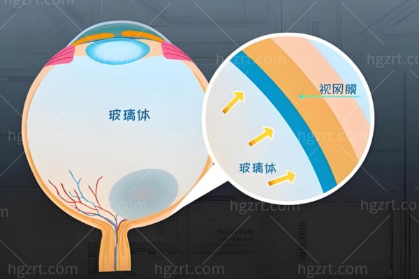 视网膜脱落后眼睛会变成怎样?手术后要趴多久?手术后能复原正常视力吗?