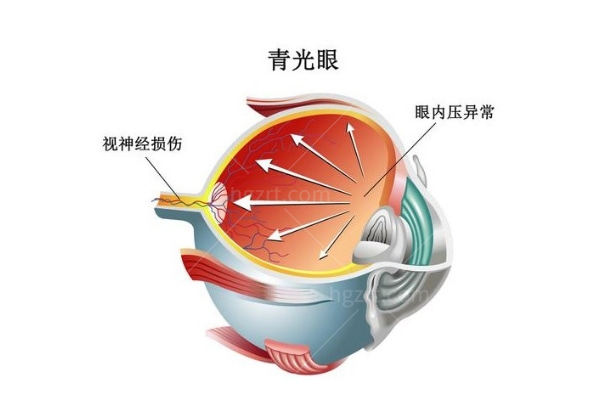 得了青光眼意味着什么