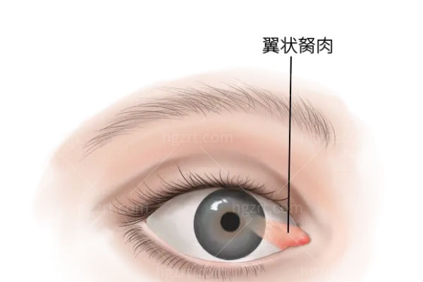 割了胬肉20天眼睛突然又红是怎么回事