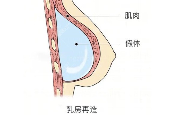 武汉徐国建医生隆胸怎么样