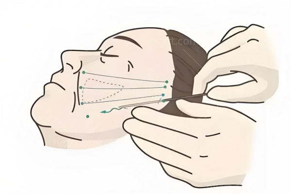 韧带线面部提升和埋线提升有什么区别 从方式原理来看改善皮肤松弛面部轮廓有效