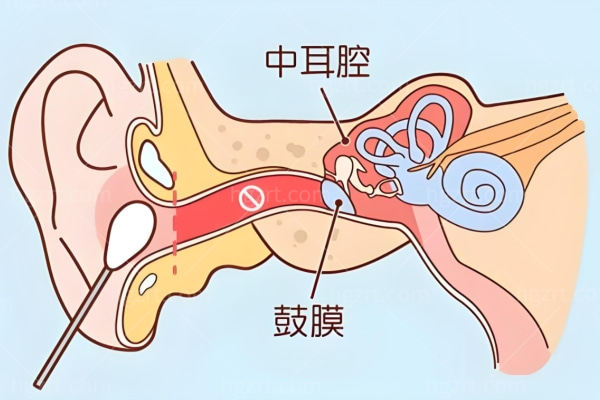 环缩耳是什么原因引起的?有必要矫正吗?内附价格表