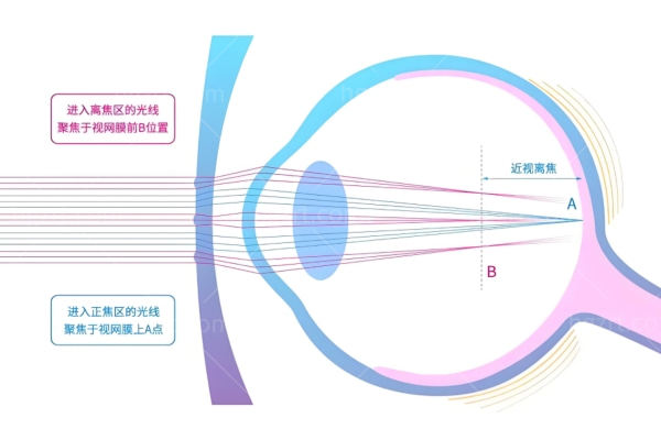 明月轻松控pro镜片和星趣控哪个好? 从原理/材料/舒适度/价格/折射率来分析