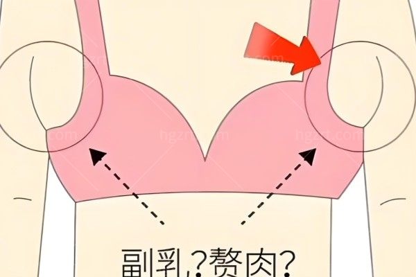 副乳切除手术是微创吗?手术大概需要多少钱?会自己慢慢消除吗?