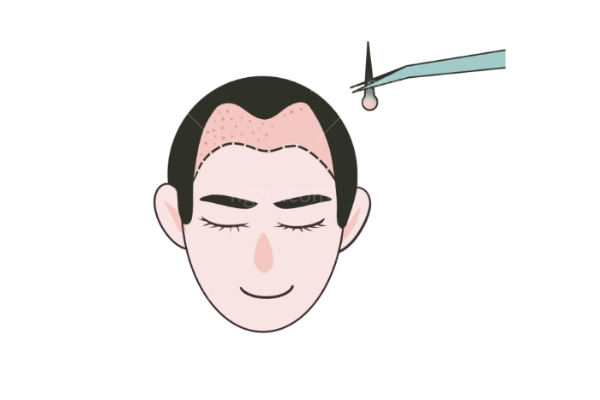 大连亲和植发医院价格贵吗