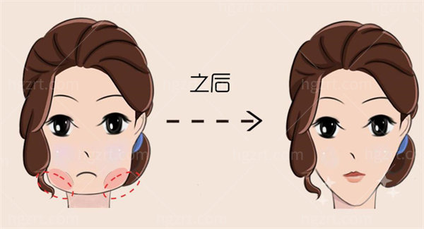 光纤溶脂和吸脂手术区别