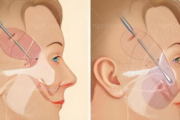 SMAS提升术与传统拉皮有什么区别