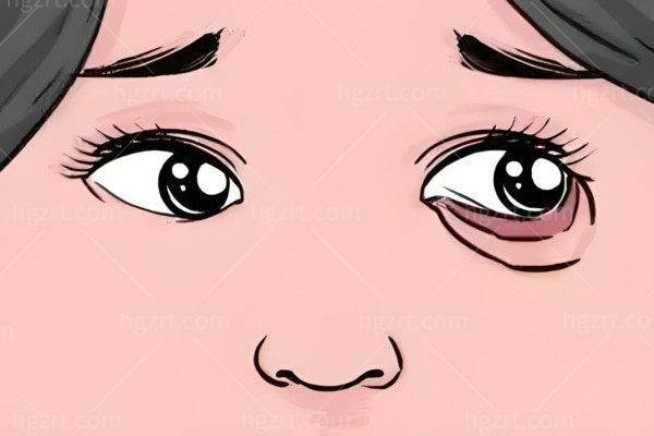 眼睑内翻矫正术属于几级手术?手术1-2小时价格3000元起安适性高